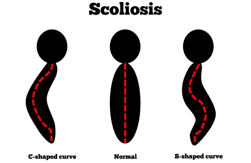 Olive Branch, Hernando, and Horn Lake, Minnesota scoliosis treatment